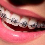 Aparelho ortodôntico metálico - ARTEODONTO CLINICA